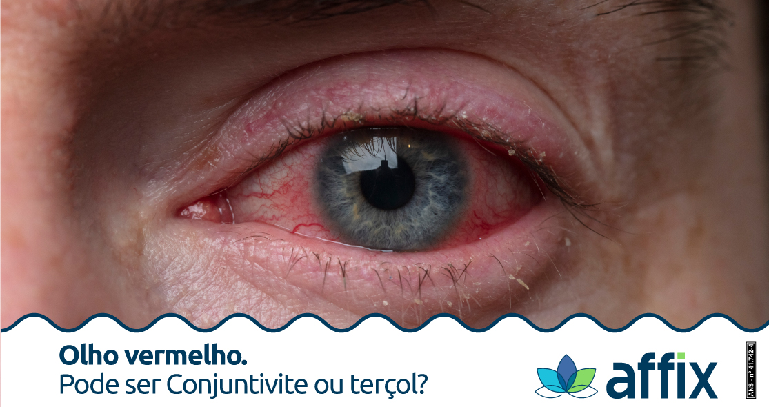 Acordou com o olho inchado, doendo levemente e com um nódulo vermelho?  Provavelmente isso que você tem é um hordéolo ou terçol, como popularmente  é, By VISIO - Clínica de Olhos