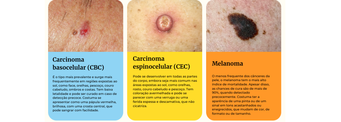Affix Blog - Dezembro Laranja - Diferentes tipos de câncer de pele